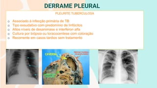 DERRAME PLEURAL
PLEURITE TUBERCULOSA
o Associado à infecção primária de TB
o Tipo exsudativo com predomínio de linfócitos
o Altos níveis de desanimase e interferon alfa
o Cultura por biópsia ou toracocentese com coloração
o Recorrente em casos tardios sem tratamento
 