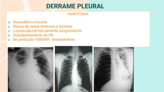 DERRAME PLEURAL
HEMOTÓRAX
o Secundário a trauma
o Rotura de vasos torácicos e tumores
o Líquido pleural francamente sanguinolento
o Acompanhamento do Hb
o Se produção >200ml/h toracocentese
 