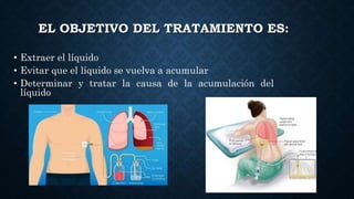 EL OBJETIVO DEL TRATAMIENTO ES:
• Extraer el líquido
• Evitar que el líquido se vuelva a acumular
• Determinar y tratar la causa de la acumulación del
líquido
 