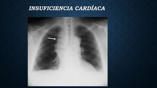 INSUFICIENCIA CARDÍACA
 