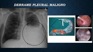 DERRAME PLEURAL MALIGNO
 