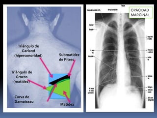 Derrame pleural y atelectasia | PPTX