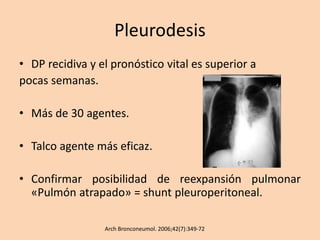Pleurodesis
• DP recidiva y el pronóstico vital es superior a
pocas semanas.
• Más de 30 agentes.
• Talco agente más eficaz.
• Confirmar posibilidad de reexpansión pulmonar
«Pulmón atrapado» = shunt pleuroperitoneal.
Arch Bronconeumol. 2006;42(7):349-72
 