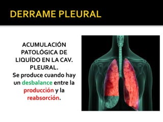 Derrame pleural y neumotorax 2019 by Md Graciela Cordova. UMSS