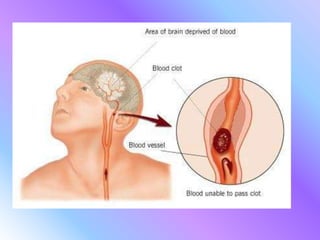 Derrames cerebrales | PPTX