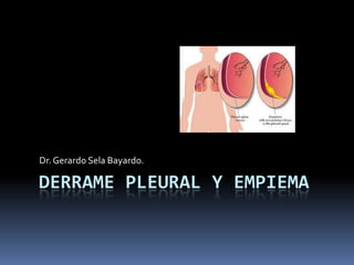 DERRAME PLEURAL Y EMPIEMA
Dr.Gerardo Sela Bayardo.
 