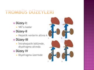 

Düzey-I:




Düzey-II




Hepatik venlerin altına kadar

Düzey-III




VKİ’a kadar

İntrahepatik bölümde,
diyafragma altında

Düzey IV


Diyafragma üzerinde

 