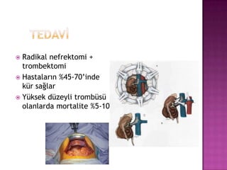 Radikal nefrektomi +
trombektomi
 Hastaların %45-70’inde
kür sağlar
 Yüksek düzeyli trombüsü
olanlarda mortalite %5-10


 