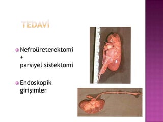  Nefroüreterektomi

+
parsiyel sistektomi
 Endoskopik

girişimler

 