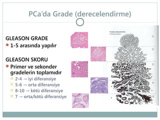 PCa’da Grade (derecelendirme)
GLEASON GRADE
 1-5 arasında yapılır
GLEASON SKORU
 Primer ve sekonder
gradelerin toplamıdır





2-4 → iyi diferansiye
5-6 → orta diferansiye
8-10 → kötü diferansiye
7 → orta/kötü diferansiye

 