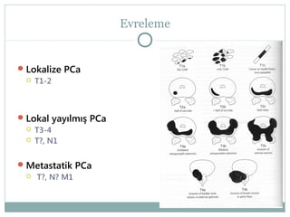 Evreleme

 Lokalize PCa
 T1-2

 Lokal yayılmış PCa
 T3-4
 T?, N1
 Metastatik PCa
 T?, N? M1

 