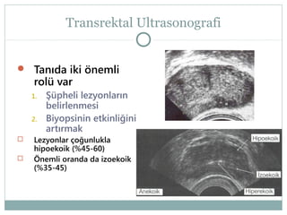 Transrektal Ultrasonografi
 Tanıda iki önemli

rolü var

1.
2.




Şüpheli lezyonların
belirlenmesi
Biyopsinin etkinliğini
artırmak

Lezyonlar çoğunlukla
hipoekoik (%45-60)
Önemli oranda da izoekoik
(%35-45)

 