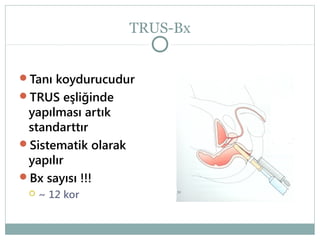 TRUS-Bx
Tanı koydurucudur
TRUS eşliğinde

yapılması artık
standarttır
Sistematik olarak
yapılır
Bx sayısı !!!


~ 12 kor

 