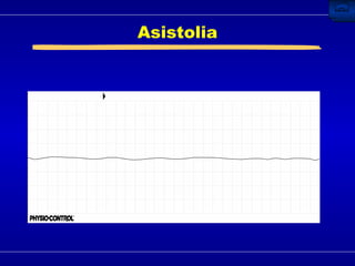Asistolia 
