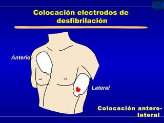 Colocación electrodos de  desfibrilación Colocación antero-lateral  Anterior Lateral 