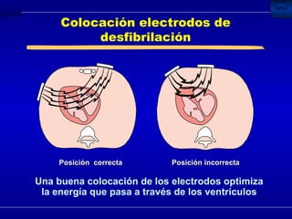 Colocación electrodos de desfibrilación Una buena colocación de los electrodos optimiza la energía que pasa a través de los ventrículos Posición  correcta Posición incorrecta 