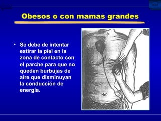 Obesos o con mamas grandes Se debe de intentar estirar la piel en la zona de contacto con el parche para que no queden burbujas de aire que disminuyan la conducción de energía. 