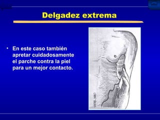 Delgadez extrema En este caso también apretar cuidadosamente el parche contra la piel para un mejor contacto. 