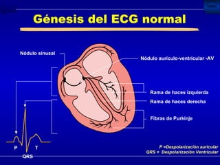 Génesis del ECG normal QRS Nódulo sinusal Nódulo aurículo-ventricular -AV Rama de haces izquierda Rama de haces derecha Fibras de Purkinje  P =Despolarización auricular QRS =  Despolarización Ventricular P T 