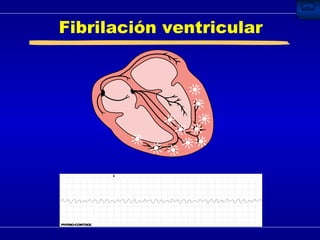 Fibrilación ventricular 