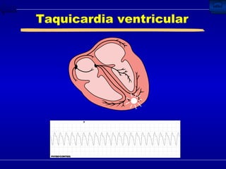 Taquicardia ventricular 