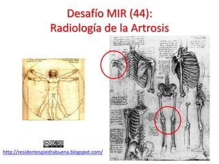Desafío MIR (44):
                   Radiología de la Artrosis




http://residentespiedrabuena.blogspot.com/
 