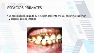 ESPACIOS PRIMATES
• El espaciado localizado suele estar presente mesial al canino superior
y distal al canino inferior
 