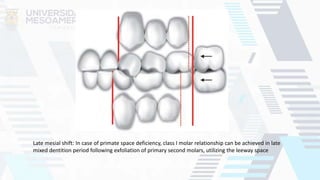 Late mesial shift: In case of primate space deficiency, class I molar relationship can be achieved in late
mixed dentition period following exfoliation of primary second molars, utilizing the leeway space
 