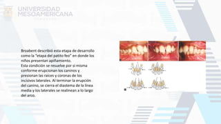 Broabent describió esta etapa de desarrollo
como la “etapa del patito feo” en donde los
niños presentan apiñamiento.
Esta condición se resuelve por si misma
conforme erupcionan los caninos y
presionan las raíces y coronas de los
incisivos laterales. Al terminar la erupción
del canino, se cierra el diastema de la línea
media y los laterales se realinean a lo largo
del arco.
 