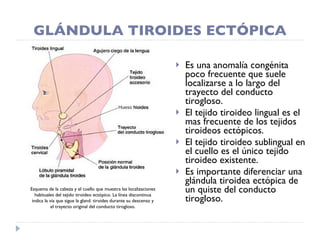 GLÁNDULA TIROIDES ECTÓPICA Es una anomalía congénita poco frecuente que suele localizarse a lo largo del trayecto del conducto tirogloso. El tejido tiroideo lingual es el mas frecuente de los tejidos tiroideos ectópicos. El tejido tiroideo sublingual en el cuello es el único tejido tiroideo existente. Es importante diferenciar una glándula tiroidea ectópica de un quiste del conducto tirogloso. Esquema de la cabeza y el cuello que muestra las localizaciones habituales del tejido tiroideo ectópico. La línea discontinua indica la vía que sigue la gland. tiroides durante su descenso y el trayecto original del conducto tirogloso. 