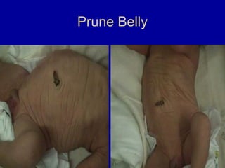 Prune Belly