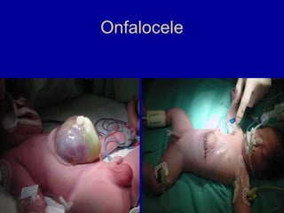 Onfalocele