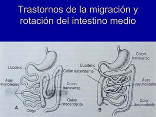Trastornos de la migración y
rotación del intestino medio