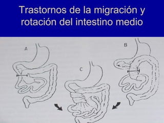 Trastornos de la migración y
rotación del intestino medio