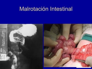 Malrotación Intestinal