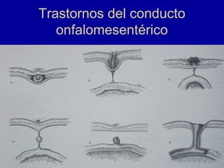 Trastornos del conducto
onfalomesentérico