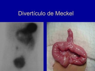 Divertículo de Meckel