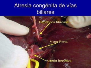 Atresia congénita de vías
biliares