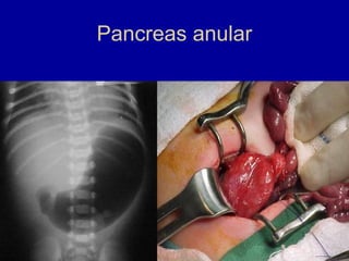 Pancreas anular