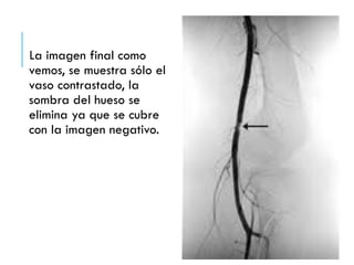 La imagen final como
vemos, se muestra sólo el
vaso contrastado, la
sombra del hueso se
elimina ya que se cubre
con la imagen negativo.
 