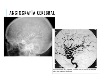 ANGIOGRAFÍA CEREBRAL
 