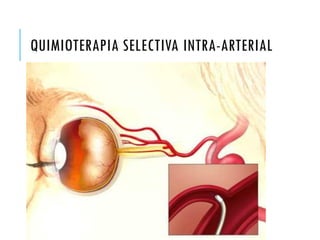 QUIMIOTERAPIA SELECTIVA INTRA-ARTERIAL
 