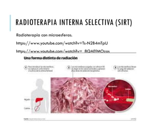 RADIOTERAPIA INTERNA SELECTIVA (SIRT)
Radioterapia con microesferas.
https://www.youtube.com/watch?v=Ts-N2B4mTpU
https://www.youtube.com/watch?v=_8QAEfMOzos
 