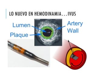 LO NUEVO EN HEMODINAMIA…IVUS
 