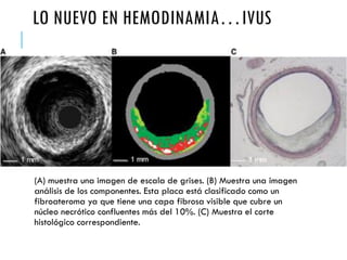 (A) muestra una imagen de escala de grises. (B) Muestra una imagen
análisis de los componentes. Esta placa está clasificado como un
fibroateroma ya que tiene una capa fibrosa visible que cubre un
núcleo necrótico confluentes más del 10%. (C) Muestra el corte
histológico correspondiente.
LO NUEVO EN HEMODINAMIA…IVUS
 