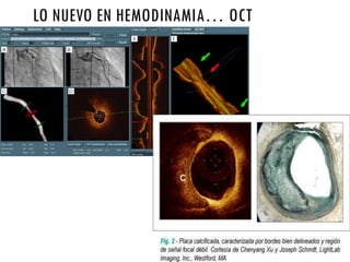 LO NUEVO EN HEMODINAMIA… OCT
 
