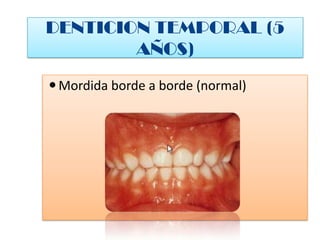 DENTICION TEMPORAL (5 AÑOS) ,[object Object],[object Object]