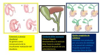 Estenosis o atresia
duodenal
Se genera como
consecuencia de la
insuficiente realización del
duodeno.
Conducto biliar accesorio
Drena el hígado
directamente a la vesícula
biliar hacia la cavidad
peritoneal después de una
colecistectomía.
Quiste congénito de
colédoco
Anomalía rara producida
por una zona de debilidad
en la pared del colédoco
El quiste puede tener
hasta dos litros de bilis
 