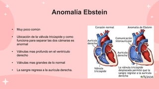 Anomalía Ebstein
• Muy poco común
• Ubicación de la válvula tricúspide y como
funciona para separar las dos cámaras es
anormal
• Válvulas mas profundo en el ventrículo
derecho
• Válvulas mas grandes de lo normal
• La sangre regresa a la aurícula derecha.
 