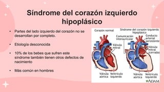 Síndrome del corazón izquierdo
hipoplásico
• Partes del lado izquierdo del corazón no se
desarrollan por completo.
• Etiología desconocida
• 10% de los bebes que sufren este
síndrome también tienen otros defectos de
nacimiento
• Más común en hombres
 